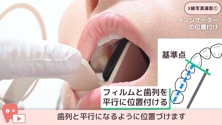 02.上顎大臼歯の撮影手順