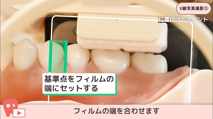 03.下顎大臼歯の撮影手順