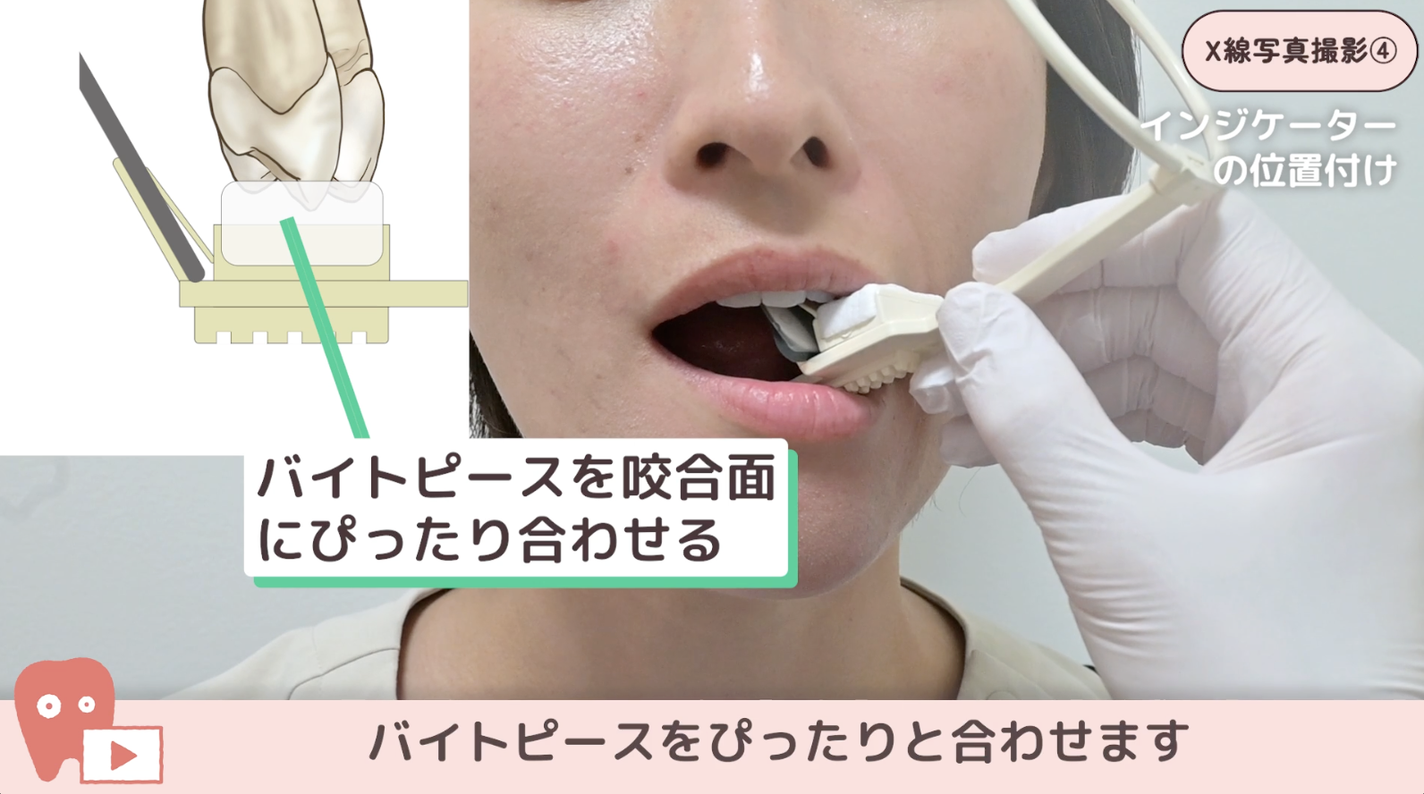 04.上顎小臼歯・犬歯の撮影手順