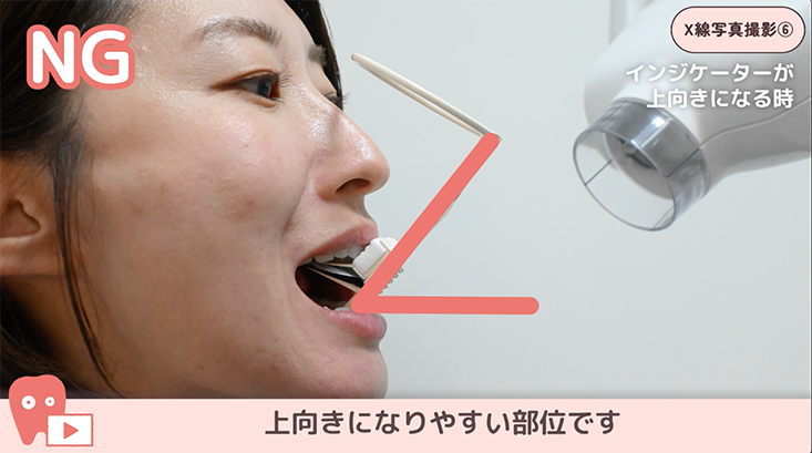 06.上顎前歯の撮影手順