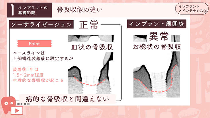 ☆03.インプラントの基礎知識編③-インプラントの正常と異常-
