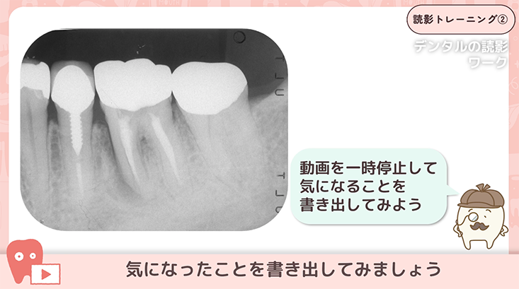 02.デンタルに写らないカリエス