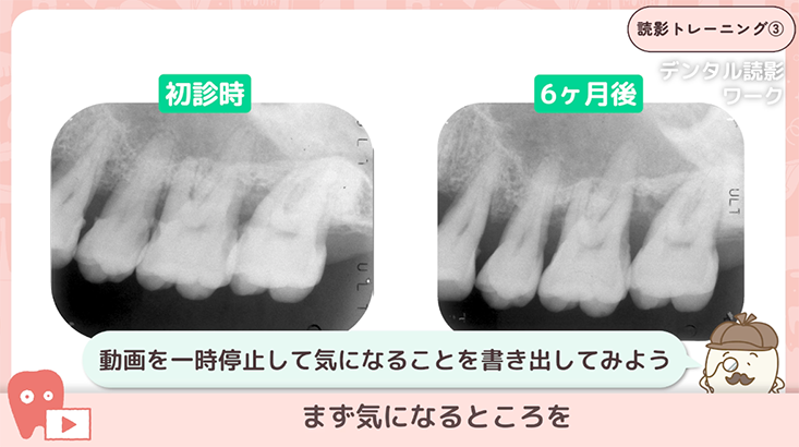 03.重度ペリオの経過