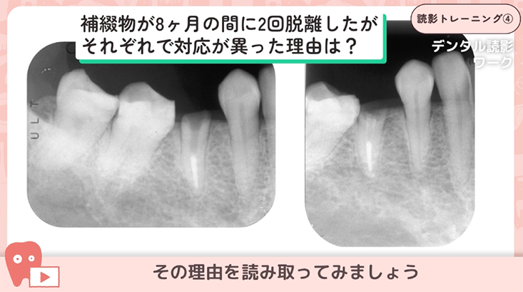 04.２度目の脱離