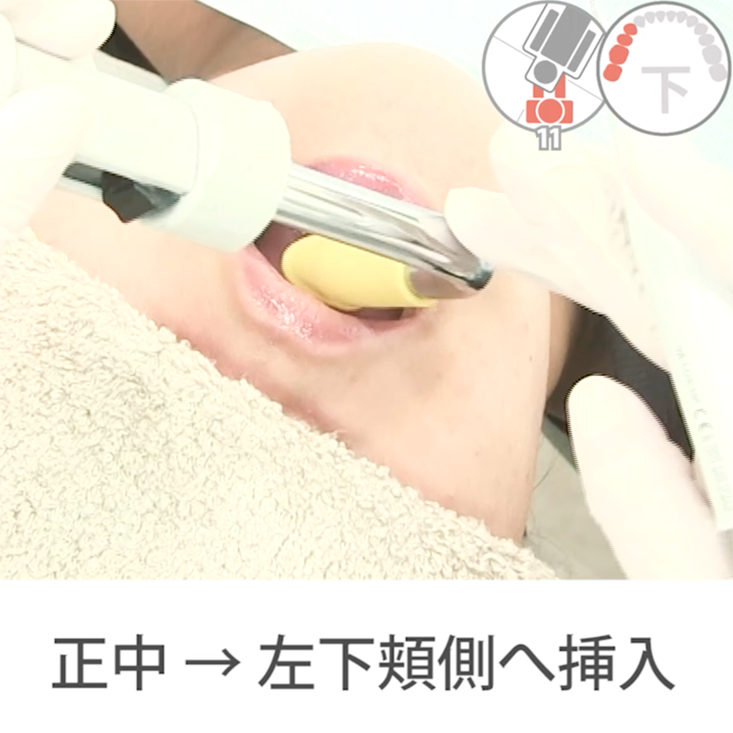 01. 左下臼歯部頬側・舌側　その1